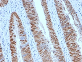 Recombinant CDX2 Antibody Human Colon Carcinoma Tissue IHC. Immunohistochemistry testing of FFPE human colon carcinoma with recombinant CDX2 antibody (clone CDX2/2951R). HIER: boil tissue sections in 10mM Tris with 1mM EDTA, pH 9, for 10-20 min followed by cooling prior to testing.