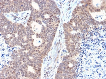 FAF1 Antibody Colon Carcinoma IHC. Immunohistochemistry testing of FFPE human colon carcinoma with FAF1 antibody. HIER: boiling tissue sections in 10mM citrate buffer, pH 6, for 10-20 min and allow to cool prior to staining.