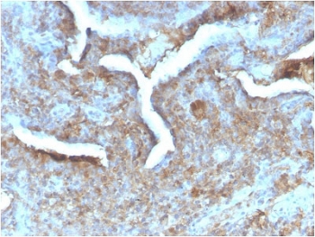 Thymidine Phosphorylase Antibody Prostate Carcinoma IHC. Immunohistochemistry analysis of FFPE human prostate carcinoma tissue stained with Thymidine Phosphorylase antibody detecting TYMP, clone TYMP/2890R. Tumor epithelial cells show cytoplasmic staining with moderate intensity, consistent with localization of TYMP as a cytosolic enzyme involved in nucleotide metabolism and angiogenesis-associated processes. The staining highlights malignant glandular structures, while surrounding stromal regions show comparatively reduced signal. Hematoxylin counterstain highlights nuclei in blue. HIER: boil tissue sections in 10 mM citrate buffer, pH 6, for 10-20 min and allow to cool before testing.