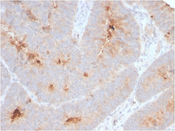 ECM1 Antibody Colon Carcinoma IHC. Immunohistochemistry analysis of FFPE human colon carcinoma tissue stained with ECM1 antibody detecting Extracellular matrix protein 1. Tumor epithelial cells show cytoplasmic and extracellular staining with focal accumulation in the surrounding matrix, consistent with ECM1 as a secreted glycoprotein involved in extracellular matrix organization and tumor microenvironment interactions. The staining highlights areas of matrix remodeling within malignant tissue, while stromal regions show variable signal. Hematoxylin counterstain highlights nuclei in blue. HIER: boil tissue sections in pH 9 10 mM Tris with 1 mM EDTA for 10-20 min and allow to cool before testing.