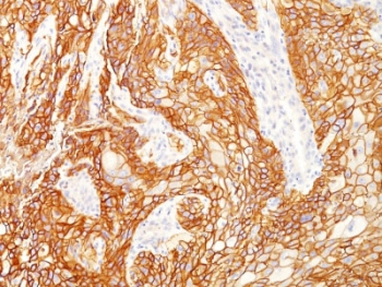EGFRvIII Antibody Lung Squamous Cell Carcinoma IHC. Immunohistochemistry testing of FFPE human lung squamous cell carcinoma with recombinant EGFRvIII antibody (clone GFR/2600R). Required HIER: boiling tissue sections in pH 9 10mM Tris with 1mM EDTA for 10-20 min and allow to cool prior to testing.
