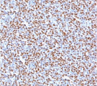 ALK Antibody Neoplastic Lymphoid Cell IHC. Immunohistochemistry staining of FFPE human anaplastic large-cell lymphoma tissue using recombinant monoclonal clone ATKR-2R demonstrates strong nuclear and cytoplasmic HRP-DAB brown staining in malignant lymphoid cells, supporting detection of ALK fusion-associated oncogenic kinase expression within lymphoma-derived tumor tissue. The staining pattern is characteristic of ALK-positive anaplastic large-cell lymphoma and associated receptor tyrosine kinase pathway activation. HIER: boil tissue sections in 10mM Tris buffer with 1mM EDTA, pH 9, for 10-20 min followed by cooling at room temperature for 20 min.