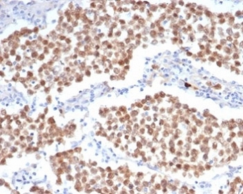 IHC staining of FFPE human seminoma tissue with OCT4 antibody (clone OCT4/6847R). HIER: boil tissue sections in pH 9 10mM Tris with 1mM EDTA for 20 min and allow to cool before testing.