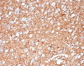 IHC staining of FFPE human brain tissue with GFAP antibody (clone GFAP/6884). HIER: boil tissue sections in pH 9 10mM Tris with 1mM EDTA for 20 min and allow to cool before testing.
