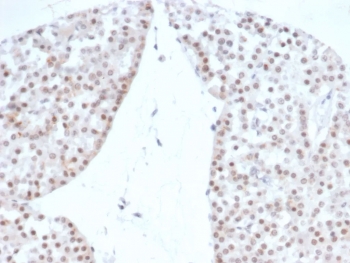 Recombinant Steroidogenic Factor 1 Antibody Renal Oncocytoma IHC. Immunohistochemistry staining of FFPE human renal oncocytoma with Recombinant Steroidogenic Factor 1 antibody (clone rNR5A1/4369). HIER: boil tissue sections in pH 9 10mM Tris with 1mM EDTA for 20 min and allow to cool before testing.