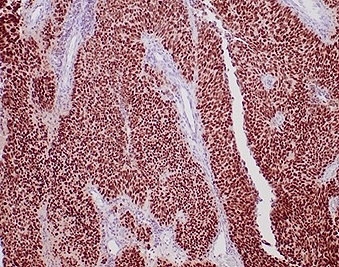 Recombinant GATA Binding Protein 3 Antibody Urothelial Carcinoma IHC. Immunohistochemistry analysis of FFPE human urothelial carcinoma tissue stained with recombinant GATA Binding Protein 3 antibody clone rGATA3/3870 demonstrates strong diffuse nuclear HRP-DAB brown staining throughout malignant urothelial cell populations, consistent with the established role of GATA binding protein 3 / GATA3 in urothelial differentiation and epithelial lineage-associated transcriptional regulation. The extensive nuclear staining pattern supports the utility of GATA3 as a marker of urothelial epithelial identity in bladder carcinoma-associated tissue studies. HIER: boil tissue sections in pH 9 10mM Tris with 1mM EDTA for 20 min and allow to cool before testing.