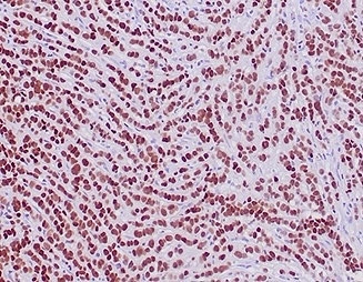 Recombinant GATA Binding Protein 3 Antibody Lobular Breast Carcinoma IHC. Immunohistochemistry analysis of FFPE human lobular breast carcinoma tissue stained with recombinant GATA Binding Protein 3 antibody clone rGATA3/3870 demonstrates strong diffuse nuclear HRP-DAB brown staining throughout malignant epithelial cell populations, consistent with the established role of GATA binding protein 3 / GATA3 in luminal epithelial differentiation and mammary lineage-associated transcriptional regulation. The extensive nuclear localization pattern supports the use of GATA3 as a marker of breast epithelial identity in carcinoma-associated tissue studies. HIER: boil tissue sections in pH 9 10mM Tris with 1mM EDTA for 20 min and allow to cool before testing.