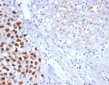 Immunohistochemistry analysis of SALL4 / ZNF797 antibody (clone SALL4/7301) in human pancreas tissue. FFPE human pancreas sections show nuclear HRP-DAB brown staining in a subset of epithelial cells, while surrounding stromal elements demonstrate minimal to no specific signal. The staining pattern is predominantly nuclear, consistent with the expected localization of Sal-like protein 4 as a zinc finger transcription factor. Background staining is low, and cellular morphology is well preserved. The negative control inset, in which PBS was used instead of primary antibody, shows absence of brown chromogenic signal, confirming specificity of primary antibody binding. Heat-induced epitope retrieval was performed by boiling tissue sections in pH 9 10mM Tris with 1mM EDTA for 20 min followed by cooling prior to immunostaining.
