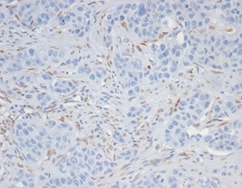 IHC staining of FFPE human kidney cancer tissue with SALL4 antibody (clone SALL4/7301). HIER: boil tissue sections in pH 9 10mM Tris with 1mM EDTA for 20 min and allow to cool before testing.