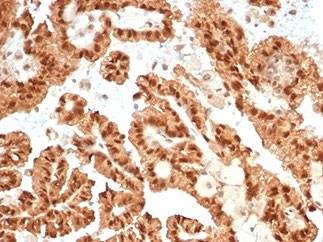 Immunohistochemistry analysis of STAT6 antibody in human renal cell carcinoma tissue (clone STAT6/7163R). FFPE human renal cell carcinoma sections demonstrate strong HRP-DAB brown nuclear staining in tumor epithelial cells forming papillary and glandular structures. The predominant nuclear localization is consistent with activated Signal transducer and activator of transcription 6, reflecting cytokine-driven phosphorylation and nuclear translocation. Cytoplasmic staining can be seen, and surrounding stromal elements show limited background signal. Heat induced epitope retrieval was performed by boiling tissue sections in pH 9 10 mM Tris with 1 mM EDTA for 20 minutes followed by cooling prior to antibody incubation.