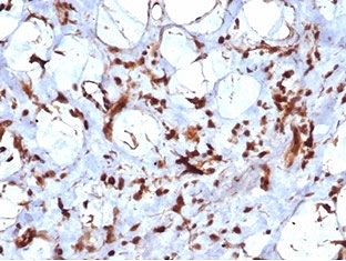 IHC staining of FFPE human liposarcoma tissue with recombinant STAT6 antibody (clone STAT6/7163R). HIER: boil tissue sections in pH 9 10mM Tris with 1mM EDTA for 20 min and allow to cool before testing.