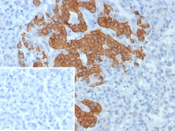 GAD2 Antibody Human Pancreas Tissue IHC. Immunohistochemistry of GAD2 Antibody Rabbit Monoclonal GAD2/8394R in human pancreas. Formalin-fixed, paraffin-embedded human pancreatic tissue demonstrates strong HRP-DAB brown cytoplasmic staining in islet cells, consistent with Glutamate decarboxylase 2 / GAD65 expression in pancreatic neuroendocrine cells. Surrounding exocrine acinar tissue shows minimal staining. The inset shows PBS used in place of the primary antibody as a negative control. Heat-induced epitope retrieval was performed by boiling tissue sections in pH 9 10mM Tris with 1mM EDTA for 20 min followed by cooling prior to antibody incubation.