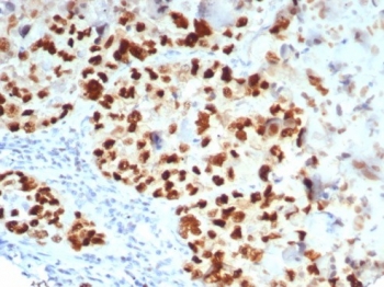 GATA-3 Antibody Lung Carcinoma Tissue IHC. Immunohistochemistry staining of FFPE human lung carcinoma tissue with GATA-3 antibody (clone GATA3/7685R). HIER: boil tissue sections in pH 9 10mM Tris with 1mM EDTA for 20 min and allow to cool before testing.