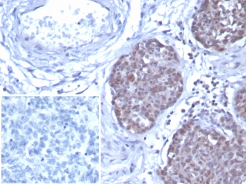 GATA-3 Antibody Ovarian Cancer Tissue IHC. Immunohistochemistry staining of FFPE human ovarian cancer tissue with GATA-3 antibody (clone GATA3/7686R). Inset: PBS used in place of primary Ab (secondary Ab negative control). HIER: boil tissue sections in pH 9 10mM Tris with 1mM EDTA for 20 min and allow to cool before testing.