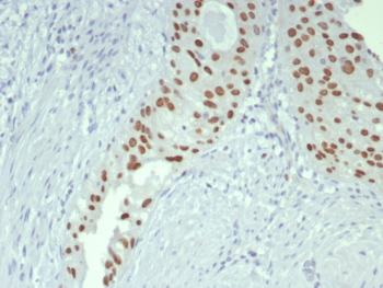 IHC staining of FFPE human bladder tissue with GATA-3 antibody (clone GATA3/7686R). HIER: boil tissue sections in pH 9 10mM Tris with 1mM EDTA for 20 min and allow to cool before testing.