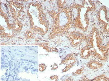 IHC staining of FFPE human prostate carcinoma tissue with RET/Receptor Tyrosine Kinase RET Proto-oncogene antibody (clone RET/7690). Inset: PBS used in place of primary Ab (secondary Ab negative control). HIER: boil tissue sections in pH 9 10mM Tris with 1mM EDTA for 20 min and allow to cool before testing.