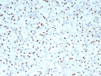 Immunohistochemistry analysis of PAX2 antibody in human renal cell carcinoma. FFPE human renal cell carcinoma tissue was stained with PAX2 antibody (clone PAX2/8671R) at 2 ug/ml. HRP-DAB brown chromogenic signal is observed predominantly in the nuclei of tumor epithelial cells, consistent with the expected nuclear localization of Paired box protein 2. Tumor cells show strong nuclear brown staining, while surrounding stromal elements display minimal to no signal. Heat-induced epitope retrieval was performed by boiling tissue sections in 10 mM Tris with 1 mM EDTA, pH 9, for 20 minutes followed by cooling prior to antibody incubation.