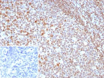IHC staining of FFPE human tonsil tissue with MGMT antibody (clone MGMT/8319R). Inset: PBS used in place of primary Ab (secondary Ab negative control). HIER: boil tissue sections in pH 9 10mM Tris with 1mM EDTA for 20 min and allow to cool before testing.