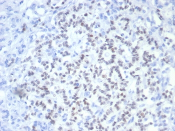 PAX6 Antibody for Immunohistochemistry analysis of human pancreatic cancer tissue. Formalin-fixed paraffin-embedded human pancreatic carcinoma stained with PAX6 Antibody for Immunohistochemistry (clone PAX6/7708). HRP-DAB brown chromogenic staining highlights nuclei of tumor cells, consistent with the expected nuclear localization of Paired Box Protein Pax-6 / PAX6. HIER: boil tissue sections in pH 9 10mM Tris with 1mM EDTA for 20 minutes and allow to cool before testing.