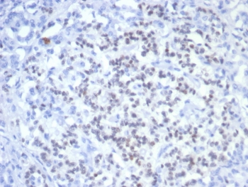 PAX6 Antibody Mouse Monoclonal PAX6/7707 immunohistochemistry analysis of human pancreatic cancer tissue. Formalin-fixed paraffin-embedded human pancreatic carcinoma stained with PAX6 Antibody Mouse Monoclonal PAX6/7707. HRP-DAB brown chromogenic staining highlights nuclei of tumor cells, consistent with the expected nuclear localization of Paired Box Protein Pax-6 / PAX6. HIER: boil tissue sections in pH 9 10mM Tris with 1mM EDTA for 20 minutes and allow to cool before testing.