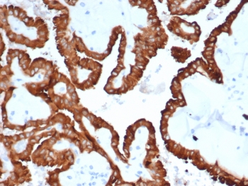 CRYAB Antibody Protein Folding IHC. Immunohistochemistry of Alpha B crystallin / CRYAB in FFPE human kidney cancer tissue using mouse monoclonal CRYAB antibody, clone CRYAB/4665. HRP-DAB brown staining highlights strong cytoplasmic labeling of tumor epithelial cells forming glandular and tubular structures, consistent with molecular chaperone activity and protein stabilization in malignant tissue, while surrounding stromal elements show minimal staining and nuclei are counterstained blue. Heat induced epitope retrieval was performed by boiling tissue sections in pH 9 10 mM Tris with 1 mM EDTA for 20 min followed by cooling prior to staining.