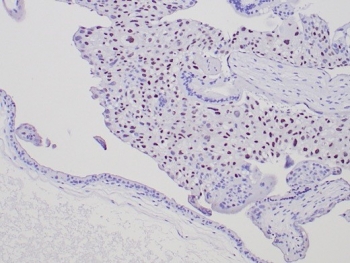 IHC staining of FFPE human complete mole (CM) tissue with p57Kip2 antibody. Strong nuclear staining observed using KIP2/7187 mAb at 2ug/ml. HIER: boil tissue sections in pH 9 10mM Tris with 1mM EDTA for 20 min and allow to cool before testing.