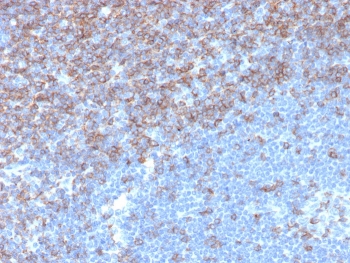 CD5 Antibody for IHC. Immunohistochemistry analysis of CD5 antibody staining in FFPE human tonsil tissue using a lymphoid malignancy marker antibody, clone rC5/6976. Strong membranous staining is observed in interfollicular T lymphocytes with dense labeling of T cell zones surrounding germinal centers, while follicular B cell areas remain largely negative. The staining pattern highlights normal tonsillar architecture and reflects the utility of CD5 in identifying lymphocyte populations relevant to lymphoid malignancy research and disease characterization. Heat-induced epitope retrieval was performed using pH 9 Tris-EDTA buffer for 20 minutes followed by cooling prior to antibody incubation.