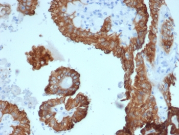CRYAB Antibody Human Kidney Carcinoma Immunohistochemistry. IHC analysis of FFPE human kidney carcinoma tissue with Crystallin Alpha B antibody (clone CRYAB/4662). HIER: boil tissue sections in pH 9 10mM Tris with 1mM EDTA for 20 min and allow to cool before testing.