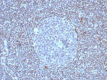 FLI1 Antibody Lymph Node IHC. Immunohistochemistry analysis of FFPE human lymph node tissue stained with recombinant FLI1 antibody (clone FLI1/8318R). Strong nuclear HRP-DAB brown staining is observed throughout lymphoid cell populations, consistent with the expected nuclear localization of Friend leukemia integration 1 transcription factor / FLI1, an ETS family transcription-associated regulatory protein involved in hematopoietic differentiation and immune cell gene expression pathways. Sections underwent HIER using 10mM Tris with 1mM EDTA buffer, pH 9, prior to immunostaining.