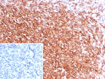 Immunohistochemistry analysis of CXCR5 antibody in human tonsil tissue. FFPE human tonsil sections show strong membranous HRP-DAB brown staining in lymphoid cells within germinal centers, consistent with CXCR5, also known as CD185, expression in follicular B cells and T follicular helper cells. Interfollicular regions show comparatively reduced staining. The inset negative control, in which PBS was used in place of primary antibody, shows no specific brown chromogenic signal. Heat induced epitope retrieval was performed by boiling tissue sections in pH 9 10 mM Tris with 1 mM EDTA for 20 minutes followed by cooling prior to staining.