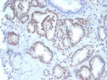 FLI1 Antibody Prostate IHC. Immunohistochemistry staining of FFPE human prostate tissue with Fli1 antibody (clone FLI1/7508). HIER: boil tissue sections in pH 9 10mM Tris with 1mM EDTA for 20 min and allow to cool before testing.