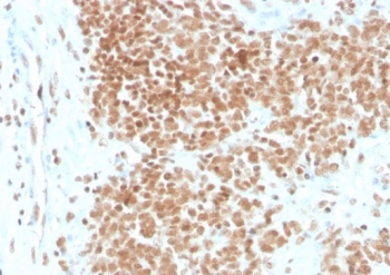 FLI1 Antibody Ewing Sarcoma IHC. Immunohistochemistry analysis of FFPE human Ewing sarcoma tissue stained with FLI1 Antibody / ETS Transcription Factor Marker (clone FLI1/4371R). Strong nuclear HRP-DAB brown staining is observed within tumor cell populations, consistent with the expected nuclear localization of Friend leukemia integration 1 / FLI1, an ETS family transcription factor associated with EWSR1-FLI1-driven oncogenic transcriptional signaling pathways in Ewing sarcoma biology. Sections underwent HIER using 10mM Tris with 1mM EDTA buffer, pH 9, prior to immunostaining.