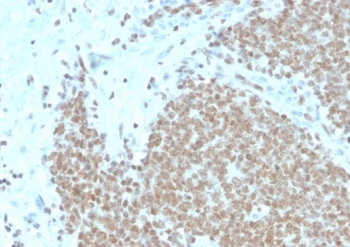 FLI1 Antibody EWS Tissue IHC. Immunohistochemistry analysis of FFPE human Ewing sarcoma (EWS) tissue stained with FLI1 Antibody / ETS Transcription Factor Marker (clone FLI1/4371R). Diffuse nuclear HRP-DAB brown staining highlights malignant tumor cells, supporting expression of Friend leukemia integration 1 / FLI1 within Ewing sarcoma-associated transcriptional regulatory pathways. Tissue sections underwent HIER using 10mM Tris with 1mM EDTA buffer, pH 9, followed by staining with recombinant rabbit monoclonal antibody clone FLI1/4371R.