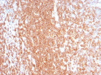 CD27 Antibody for LN IHC. Immunohistochemistry analysis of CD27 / TNFRSF7 expression in FFPE human lymph node tissue using CD27 Antibody / Tumor Immune Microenvironment Marker Antibody clone LPFS2/8574R. Strong membranous HRP-DAB brown staining is observed in dense lymphocyte populations within nodal cortical and paracortical regions, consistent with CD27 expression on activated and antigen-experienced T and B cells, while non-lymphoid stromal elements remain largely negative. The staining pattern highlights immune cell distribution and supports evaluation of lymphocyte-rich microenvironments relevant to tumor-associated immune infiltration. Heat-induced epitope retrieval was performed in pH 9 10 mM Tris with 1 mM EDTA for 20 minutes followed by cooling prior to antibody incubation.