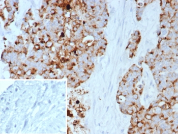 IHC staining of FFPE human bladder carcinoma with PEIG-1 antibody (clone GPRC5A/7893). Inset: PBS used in place of primary Ab (secondary Ab negative control). HIER: boil tissue sections in pH 9 10mM Tris with 1mM EDTA for 20 min and allow to cool before testing.