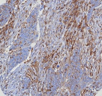 CD4 Antibody for IHC. Analysis of CD4 antibody staining in FFPE human bladder cancer tissue shows membranous labeling of CD4-positive T helper lymphocytes infiltrating tumor stroma and surrounding malignant epithelial cell nests, highlighting immune cell distribution within the tumor microenvironment. This Immune Response Regulation Antibody (clone CD4/8203R) demonstrates selective detection of CD4-expressing lymphocytes involved in regulating anti-tumor immune responses. Heat-induced epitope retrieval was performed by boiling tissue sections in pH 9 10 mM Tris with 1 mM EDTA for 20 minutes followed by cooling before testing.