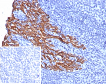 IHC staining of FFPE human tonsil tissue with recombinant KRT5 antibody (clone rKRT5/6969). Inset: PBS used in place of primary Ab (secondary Ab negative control). HIER: boil tissue sections in pH 9 10mM Tris with 1mM EDTA for 20 min and allow to cool before testing.