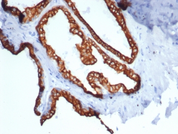 Immunohistochemistry analysis of KRT18 / Cytokeratin 18 antibody (clone rKRT18/7299) in human prostate carcinoma tissue. Formalin-fixed, paraffin-embedded human prostate carcinoma tissue was stained using recombinant KRT18 / Cytokeratin 18 antibody (clone rKRT18/7299). Heat-induced epitope retrieval was performed by boiling tissue sections in 10 mM Tris with 1 mM EDTA, pH 9.0, followed by cooling prior to antibody incubation. Brown chromogenic signal is observed in tumor epithelial cells forming glandular structures, with strong cytoplasmic staining outlining malignant epithelial cells, while surrounding stromal components show little to no staining. This staining pattern reflects epithelial cell-associated expression of Cytokeratin 18 in prostate carcinoma.