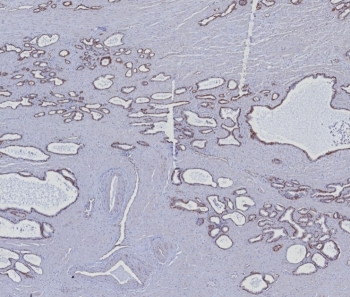 IHC staining of FFPE human prostate carcinoma tissue with Cytokeratin 5/6 antibody (clone KRT5.6/8275R). HIER: boil tissue sections in pH 9 10mM Tris with 1mM EDTA for 20 min and allow to cool before testing.