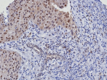 CDK4 Antibody Bladder Cancer IHC. Immunohistochemical analysis of Cyclin-dependent kinase 4 (CDK4) in formalin-fixed, paraffin-embedded human bladder cancer tissue using CDK4 antibody clone CDK4/8351R. Predominant nuclear staining is observed in tumor epithelial cells, consistent with the role of CDK4 in regulating G1 to S phase cell cycle progression, with additional weaker cytoplasmic signal in some cells. The staining pattern supports active cell cycle signaling in proliferating tumor regions. Required HIER: boil tissue sections in pH 9 10mM Tris with 1mM EDTA for 20 min and allow to cool before testing.