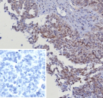 CDK4 Antibody Ovarian Cancer IHC. Immunohistochemical analysis of Cyclin-dependent kinase 4 (CDK4) in formalin-fixed, paraffin-embedded human serous ovarian cancer tissue using CDK4 antibody clone CDK4/8351R. Predominant nuclear staining is observed in tumor epithelial cells, with additional weaker cytoplasmic signal, consistent with the role of CDK4 in regulating G1 to S phase cell cycle progression. The staining highlights proliferative tumor regions and supports active cell cycle signaling. Inset: PBS used in place of primary antibody serves as a negative control for secondary antibody binding. Required HIER: boil tissue sections in pH 9 10mM Tris with 1mM EDTA for 20 min and allow to cool before testing.