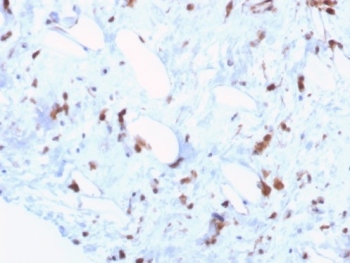 Immunohistochemistry analysis of STAT6 antibody in human liposarcoma tissue (clone STAT6/7774R). FFPE human liposarcoma sections demonstrate HRP-DAB brown nuclear staining in scattered tumor cells within a fibrous stromal background. The predominant nuclear localization is consistent with activated Signal transducer and activator of transcription 6, which translocates to the nucleus upon phosphorylation. Cytoplasmic staining is minimal, and surrounding stromal elements show limited background signal. Heat induced epitope retrieval was performed by boiling tissue sections in pH 9 10 mM Tris with 1 mM EDTA for 20 minutes followed by cooling prior to antibody incubation.