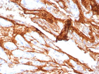 Decorin Antibody Rabbit Monoclonal Prostate IHC. Immunohistochemistry of Decorin antibody in human prostate carcinoma tissue. Formalin-fixed, paraffin-embedded human prostate carcinoma was stained using rabbit monoclonal Decorin antibody (clone DCN/8760R). Heat induced epitope retrieval was performed by boiling tissue sections in 10mM Tris with 1mM EDTA, pH 9, for 20 min followed by cooling prior to staining. HRP-DAB brown chromogenic signal highlights extracellular stromal connective tissue and desmoplastic matrix surrounding malignant glands, consistent with Decorin localization within collagen-rich tumor stroma.