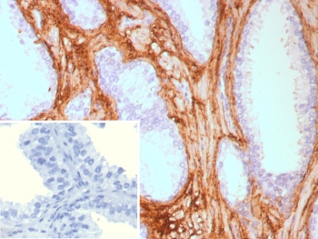 Immunohistochemistry of DCN antibody in human prostate carcinoma tissue. Formalin-fixed, paraffin-embedded human prostate carcinoma was stained using recombinant mouse monoclonal DCN antibody (clone rDCN/9075). Heat induced epitope retrieval was performed by boiling tissue sections in 10mM Tris with 1mM EDTA, pH 9, for 20 min followed by cooling prior to staining. HRP-DAB brown chromogenic signal highlights extracellular stromal matrix surrounding malignant glands, consistent with Decorin localization within collagen-rich connective tissue. The inset shows PBS used in place of primary antibody as a secondary-only negative control.