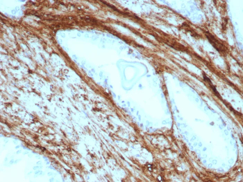 Immunohistochemistry of Decorin antibody in human prostate carcinoma tissue. Formalin-fixed, paraffin-embedded human prostate carcinoma was stained using recombinant rabbit monoclonal Decorin antibody (clone DCN/8715R). Heat induced epitope retrieval was performed by boiling tissue sections in 10mM Tris with 1mM EDTA, pH 9, for 20 min followed by cooling prior to staining. HRP-DAB brown chromogenic signal highlights extracellular stromal connective tissue surrounding malignant glands, consistent with Decorin localization within collagen-rich matrix compartments.