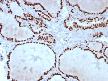 Immunohistochemistry of TTF-1 Antibody / Thyroid Epithelial Differentiation Marker Antibody in human thyroid tissue. FFPE human thyroid tissue stained using TTF-1 Antibody / Thyroid Epithelial Differentiation Marker Antibody. The mouse monoclonal clone TTF1/8427 antibody demonstrates strong nuclear staining in thyroid follicular epithelial cells lining thyroid follicles, consistent with the nuclear localization of Thyroid transcription factor 1 (NKX2-1). Nuclear immunoreactivity highlights differentiated thyroid follicular epithelial cells and reflects the established role of TTF-1 as a thyroid epithelial differentiation marker used in immunohistochemistry to identify thyroid epithelial lineage and evaluate epithelial differentiation within thyroid tissue. HIER: boil tissue sections in pH9 10mM Tris with 1mM EDTA for 20 min and allow to cool before testing.