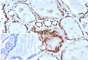 Immunohistochemistry of TTF-1 Antibody / Nuclear Homeobox Transcription Factor Antibody in human lung adenocarcinoma tissue. FFPE human lung adenocarcinoma stained using TTF-1 Antibody / Nuclear Homeobox Transcription Factor Antibody. The mouse monoclonal clone TTF1/8430 antibody demonstrates strong nuclear staining in malignant pulmonary epithelial cells, consistent with the nuclear localization of Thyroid transcription factor 1 (NKX2-1). NKX2-1 is a DNA-binding nuclear homeobox transcription factor that regulates gene expression programs involved in epithelial lineage specification and cellular differentiation. Nuclear immunoreactivity highlights transcription factor localization within tumor cell nuclei and reflects the role of NKX2-1 as a nuclear regulator of epithelial gene expression. Inset: PBS used in place of primary antibody (secondary antibody negative control). HIER: boil tissue sections in pH9 10mM Tris with 1mM EDTA for 20 min and allow to cool before testing.