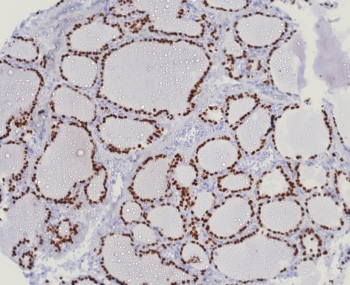 NKX2.1 Antibody for IHC / NKX2.1 Immunohistochemistry Antibody (clone TTF1/8123R) immunohistochemistry analysis of human lung adenocarcinoma tissue. Formalin-fixed, paraffin-embedded human lung adenocarcinoma stained with recombinant rabbit monoclonal clone TTF1/8123R antibody shows strong nuclear staining in malignant epithelial cells, consistent with the nuclear localization of Thyroid transcription factor 1 (NKX2-1). The nuclear immunoreactivity observed in tumor epithelial cells highlights NKX2-1 expression in lung adenocarcinoma detected by immunohistochemistry in FFPE tissue sections. HIER: boil tissue sections in pH 9 10mM Tris with 1mM EDTA for 20 min and allow to cool before testing.