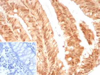 E2F4 Antibody Colon Carcinoma IHC. Immunohistochemistry staining of FFPE human colon cancer tissue with E2F4 antibody (clone E2F4/8811R). Inset: PBS used in place of primary Ab (secondary Ab negative control). HIER: boil tissue sections in pH 9 10mM Tris with 1mM EDTA for 20 min and allow to cool before testing.