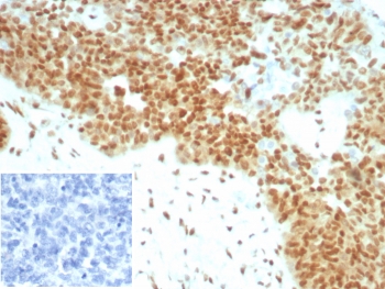 E2F4 Antibody Ovarian Carcinoma IHC. Immunohistochemistry staining of FFPE human ovarian cancer tissue with recombinant E2F4 antibody (clone E2F4/8931R). Inset: PBS used in place of primary Ab (secondary Ab negative control). HIER: boil tissue sections in pH 9 10mM Tris with 1mM EDTA for 20 min and allow to cool before testing.